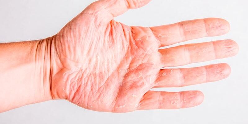Сухая кожа рук: причины и лечение