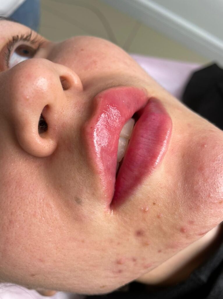 Контурная пластика губ косметолог спб
