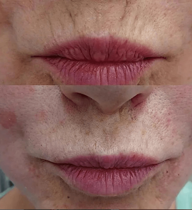 Бланширование морщин на губах