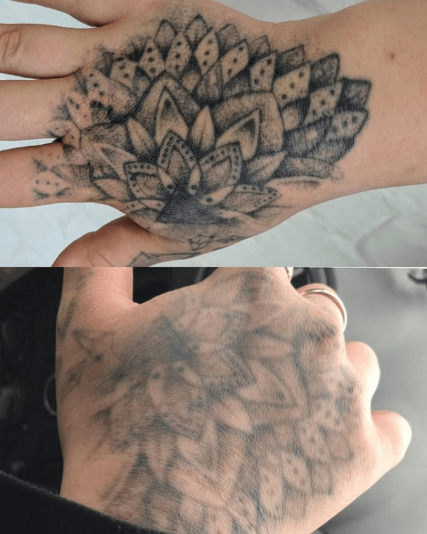 Лазерное удаление татуировки в спб