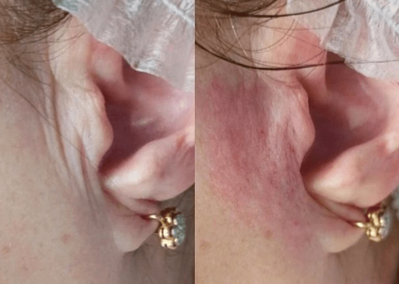 бланширование морщин возле ушей