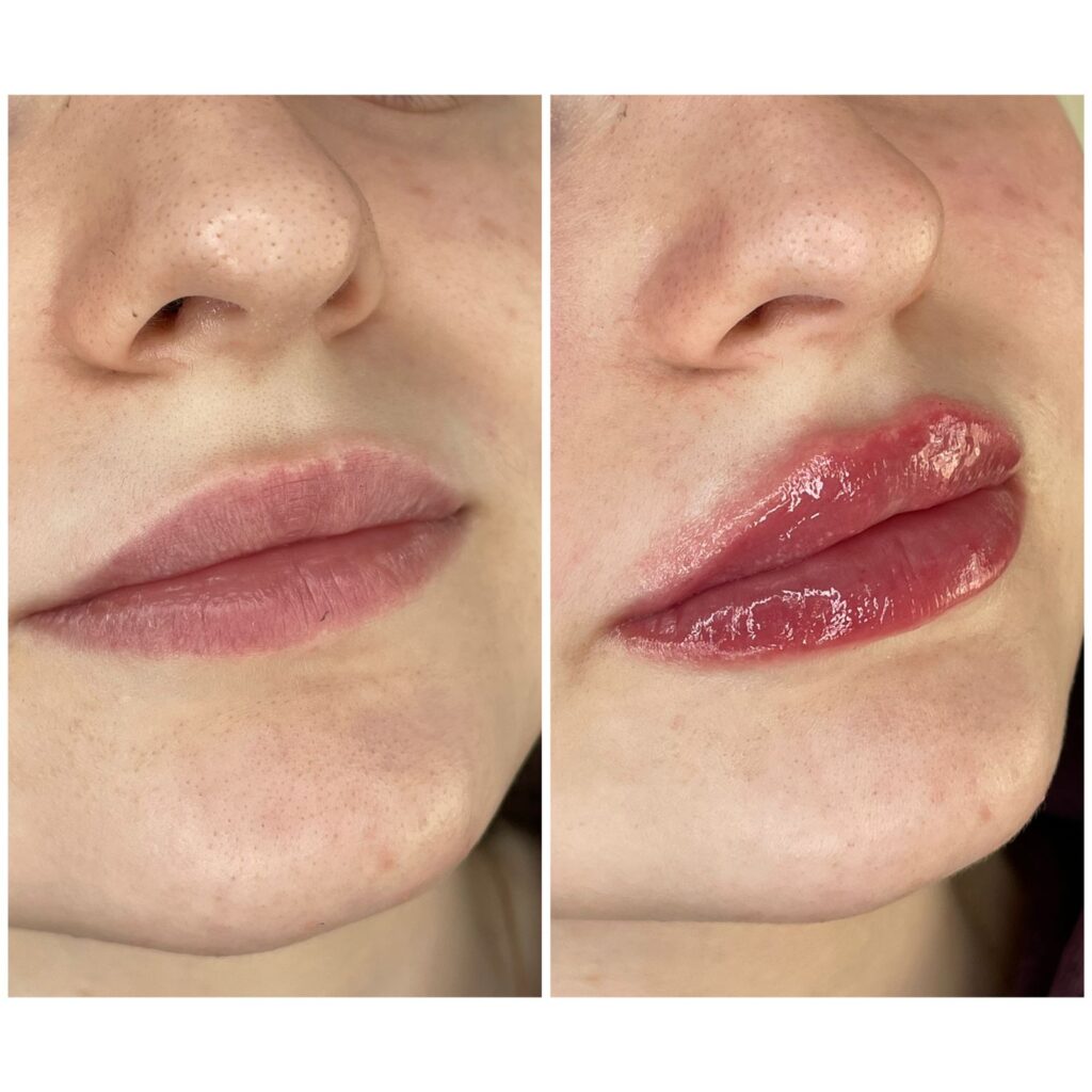 фото до и после увеличения губ